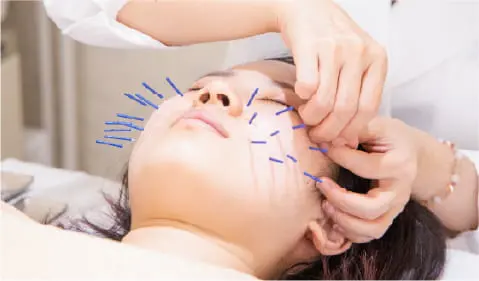 美顔鍼