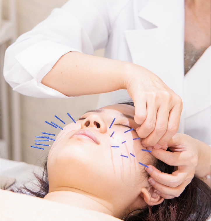 小顔鍼（美顔鍼）